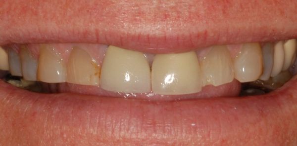 Smile of Teeth Worn by Teeth Grinding