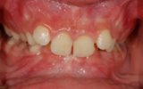 Overbite correction with a retainer