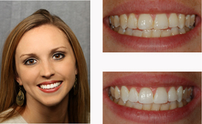 Teeth Bleaching By a Dentist in Lawrenceville GA