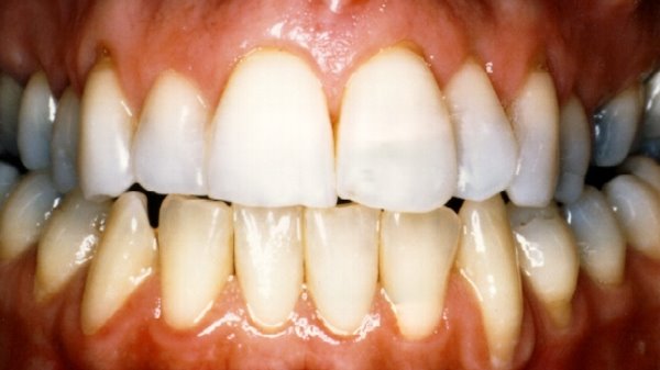 Closeup of After Teeth Bleaching