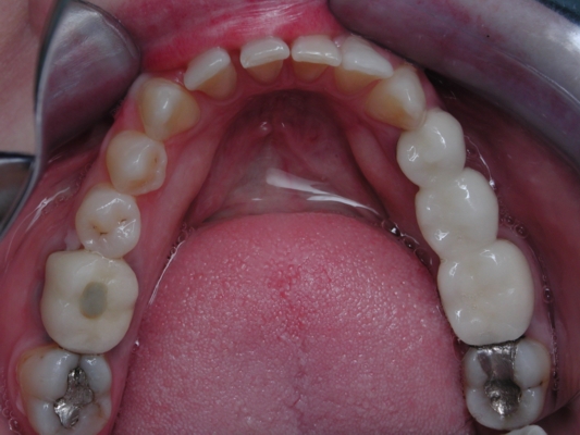 Close gaps with invisible braces before lower view