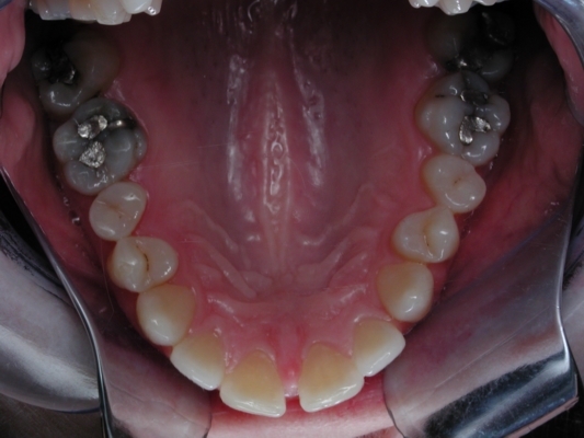 Close gap with invisible braces before upper view