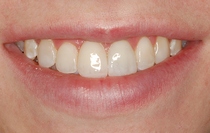 Bonding to Cover Discolored Teeth - After