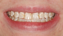 Bonding to Cover Discolored Teeth - Before