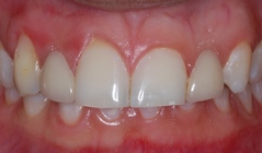 Orthodontic Missing Laterals After 7 Year Followup