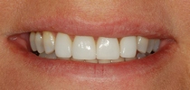Porcelain Laminates To Close Spaces Between The Front Teeth - After