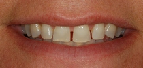 Porcelain Laminates To Close Spaces Between The Front Teeth - Before