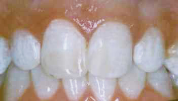 Bonding To Cover Discolorations - After