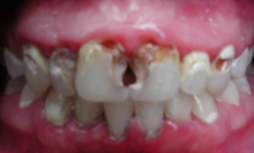 Restoring A Smile - Before