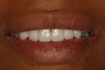 Severe Erosion Corrected With Crowns And Porcelain Laminate Veneers - After