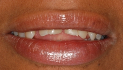 Severe Erosion Corrected With Crowns And Porcelain Laminate Veneers - Before