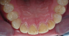 Crowns Erosion Before Upper