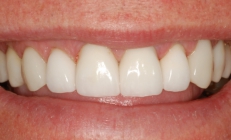 Severe Tooth Wear Corrected With Crowns - After