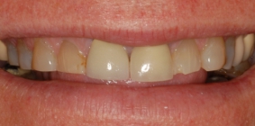 Severe Tooth Wear Corrected With Crowns - Before