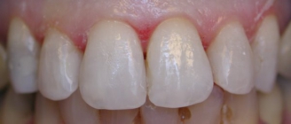 Discolored Fillings After