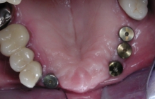 Replacement Of Missing Teeth With Implants - Before