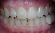 Invisible Braces After Front