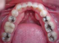 Invisible Braces After Lower