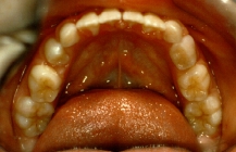 Orthodontic Crowding After 