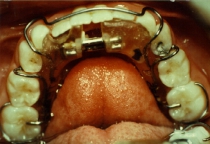 Orthodontic Crowding During Treatment  