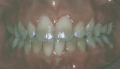 Orthodontic Crowding After Front