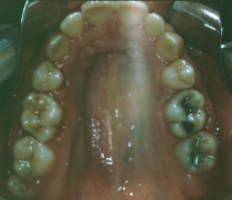 Orthodontic Crowding After Upper