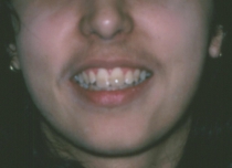 Orthodontic Crowding After Smile
