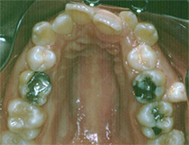 Orthodontic Crowding Before Upper
