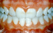 Orthodontic Crowding After Front