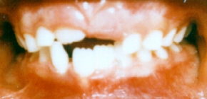 Orthodontic Crowding Before Front