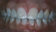 Orthodontic Missing Laterals After Front