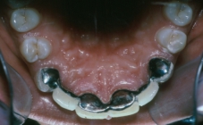 Orthodontic Missing Laterals After Upper