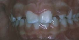 Orthodontic Missing Laterals Before Front
