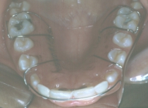 Orthodontic Missing Laterals During Treatment 