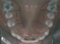 Orthodontic Missing Laterals During Treatment 