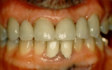 Orthodontic Missing Teeth After Front