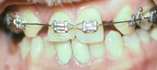Orthodontic Missing Teeth During Treatment