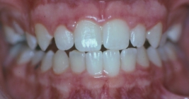 Orthodontic Overbite After Front