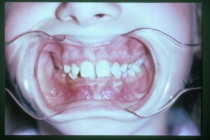 Orthodontic Overbite Before Front