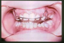 Orthodontic Overbite During Treatment
