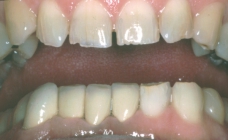 Orthodontic Worn Teeth After Front