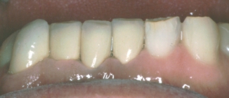Orthodontic Worn Teeth After Front