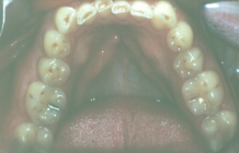 Orthodontic Worn Teeth Before Lower
