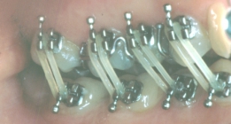 Orthodontic Worn Teeth During Treatment