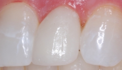 Peg Lateral Corrected With Porcelain Laminates - After