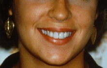 Smile with tetracycline stained teeth covered with porcelain laminates