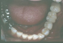 Tilted Teeth After Lower