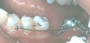 Tilted Teeth During Treatment