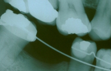 Tilted Teeth During Treatment