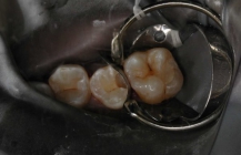 Tooth Colored Filling During Treatment